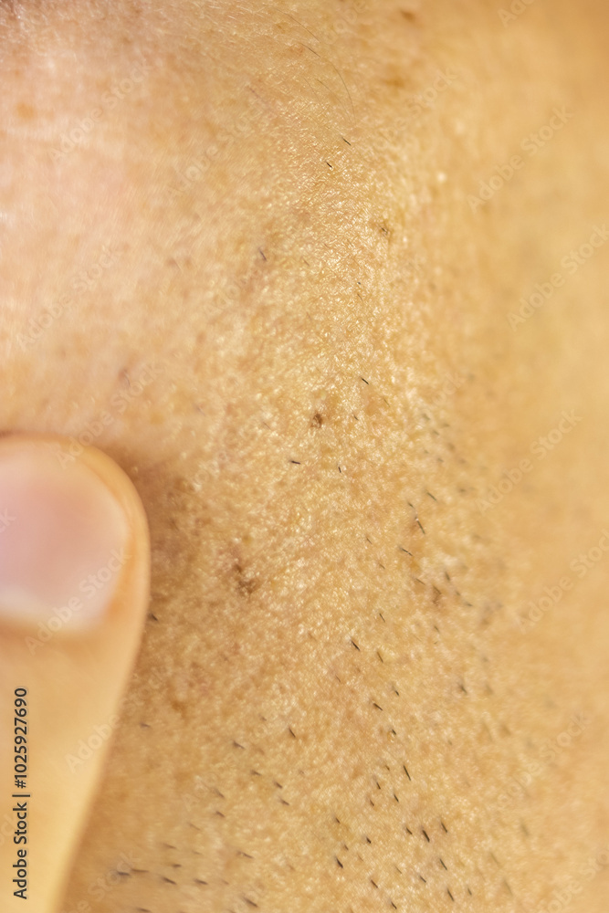 Fototapeta premium Scars after acne on mans face skin. Problem scin treatment. Close up.