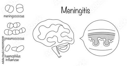 Meningitis