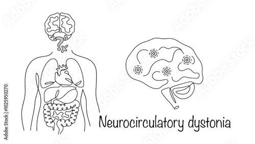Neurocirculatory dystonia