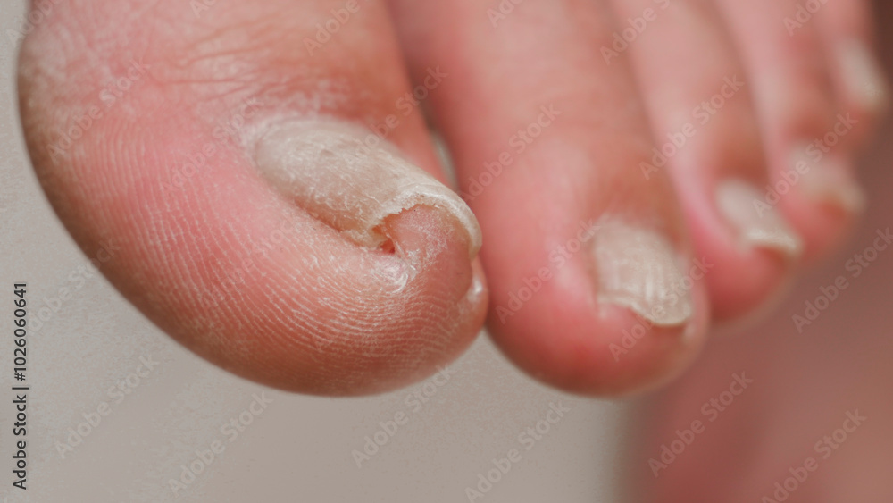 Ingrown toe nail growth in right toe causing a lot of pain Ingrown toe nail growth in right toe causing a lot of pain