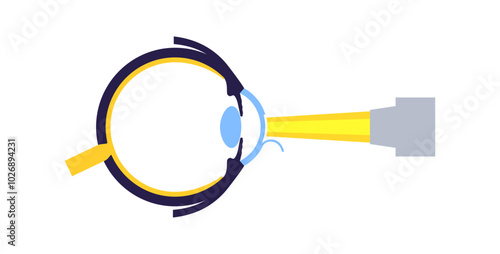 Lasik eye surgery