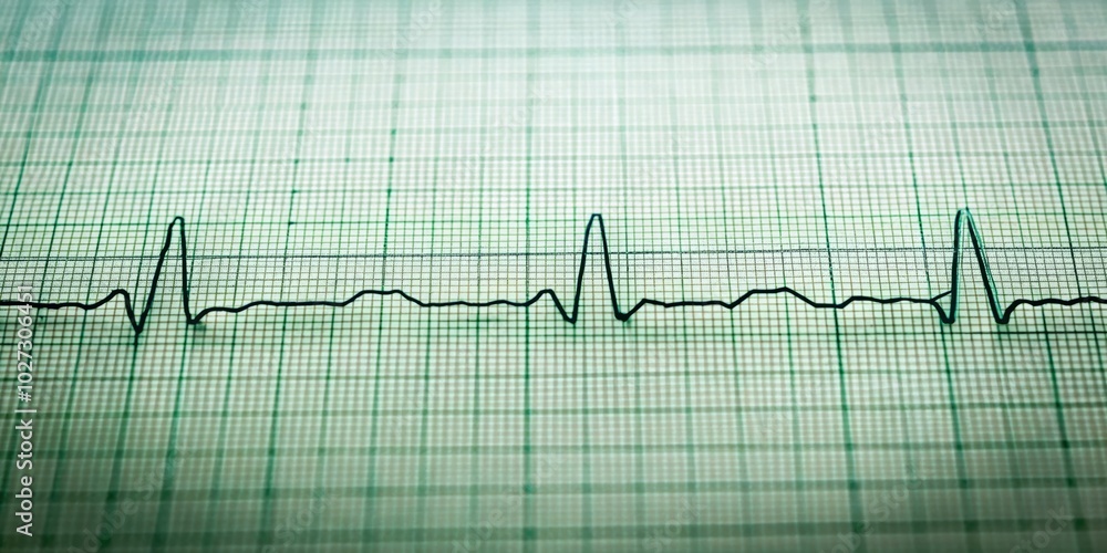 Atrial flutter ECG illustration showcases serrated waves in leads II, III, and aVF, providing essential insights for medical education and understanding cardiac arrhythmias. Atrial flutter ECG illustration showcases serrated waves in leads II, III, and aVF, providing essential insights for medical education and understanding cardiac arrhythmias.