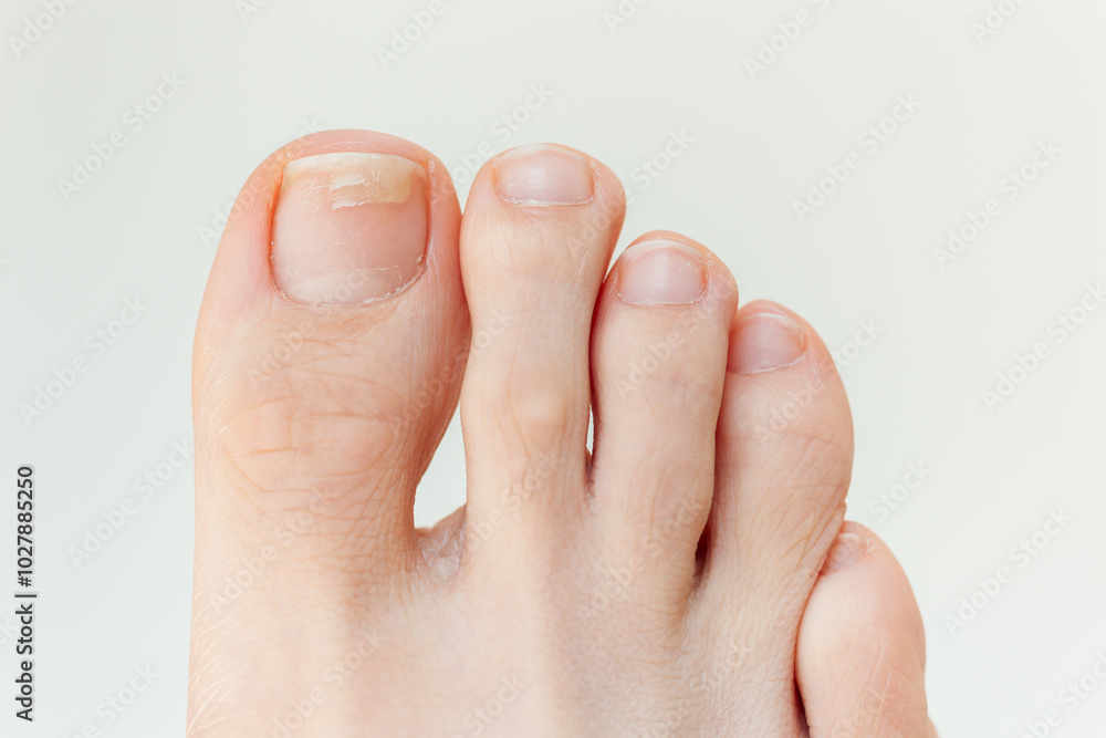 A close-up shot of a young woman's layered toenails. Lack of vitamins and minerals in the human body. Dermatology A close-up shot of a young woman's layered toenails. Lack of vitamins and minerals in the human body. Dermatology