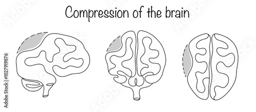Compression of the brain