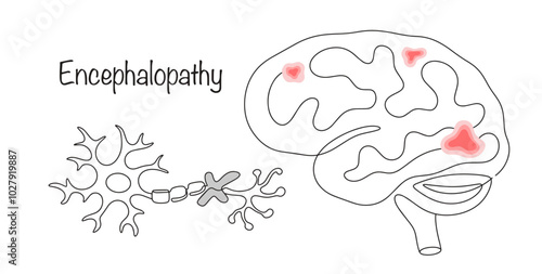Encephalopathy