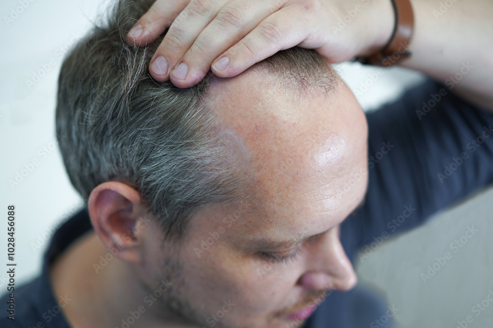 Fototapeta premium Baldness on the head of a middle-aged man. Hair loss. Alopecia