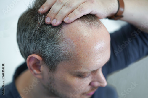 Baldness on the head of a middle-aged man. Hair loss. Alopecia