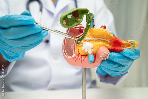 Obraz na płótnie Pancreatitis, pancreatic cancer, Asian doctor with pancreas, gallbladder and bile duct human anatomy model at hospital
