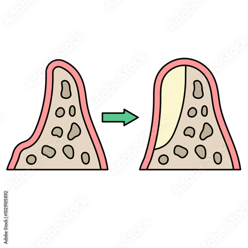 bone graft icon