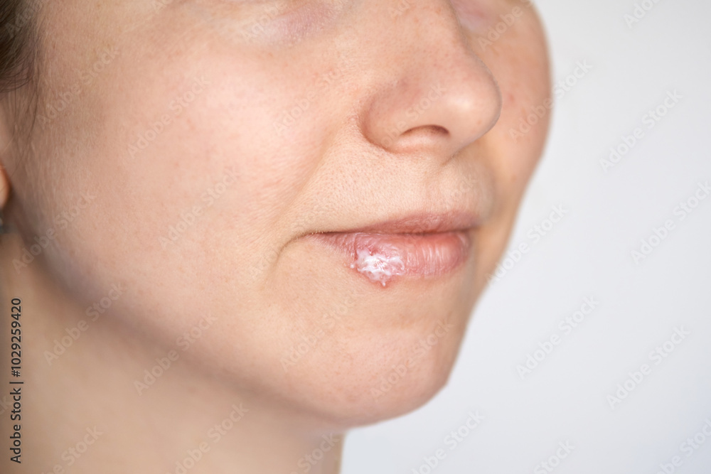 Obraz premium Close up of female face with cold sore treatment on lips - skincare concept for cold weather and lip health