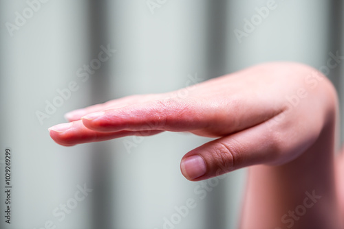 Macro closeup of female woman finger skin hand showing eczema medical condition called dyshidrotic pompholyx or vesicular dyshidrosis with blisters photo