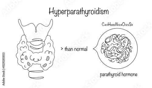 Hyperparathyroidism