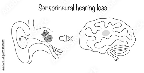 Sensorineural hearing loss