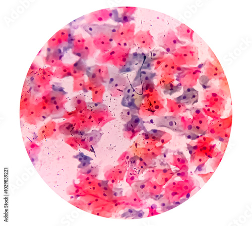 Buccal smear showing desquamated squamous cells of the oral mucosae. Small bluish points located mainly on the right cell are bacteria. Light micrograph. HE stain.