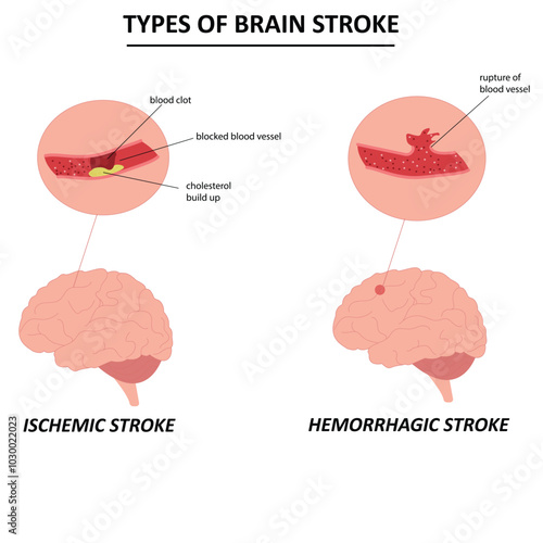 vector infographic of ischemic stroke and hemorrhagic stroke