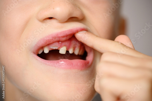 Child touching loose baby tooth, close-up. Baby teeth are replaced by permanent teeth. Children's dentistry, dental care