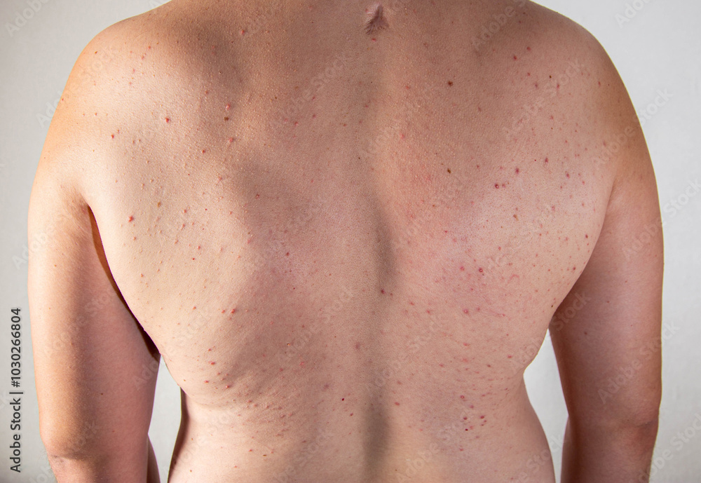Red pimples on a man's back. Skin irritation and allergy concept. Diseases of the gastrointestinal tract, close-up Red pimples on a man's back. Skin irritation and allergy concept. Diseases of the gastrointestinal tract, close-up