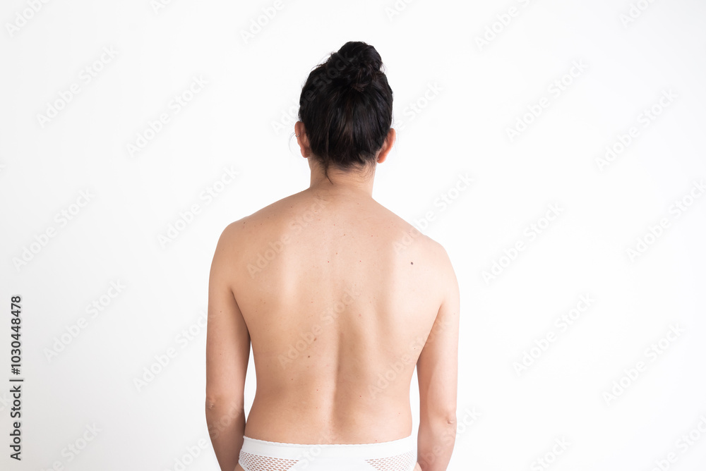 young woman, from behind, showing her back with scoliosis, pain, bad posture young woman, from behind, showing her back with scoliosis, pain, bad posture