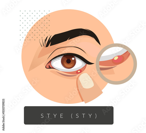 External and Internal Stye in the Eyes - Stock Illustration