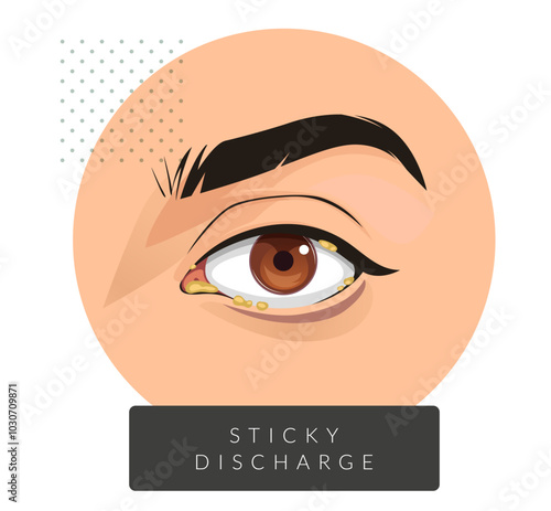 Stick Discharge from Human Eye - Stock Illustration