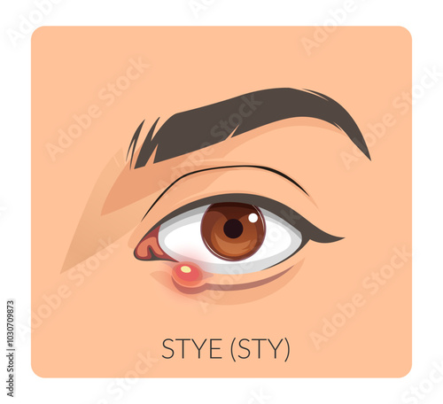 External  Stye in the Eyes - Stock Illustration