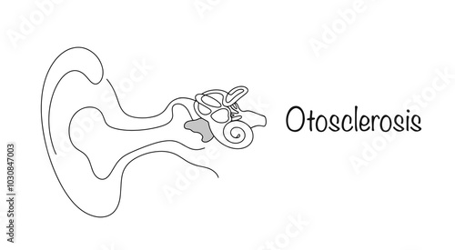 Otosclerosis