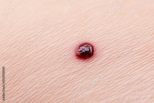 A close-up shot of a small melanoma growth, featuring uneven borders and dark coloration, set against healthy skin photo