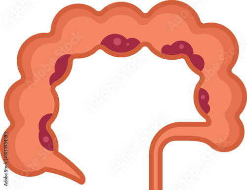 Illustration of a large intestine with diverticulitis, a digestive disorder affecting the colon
