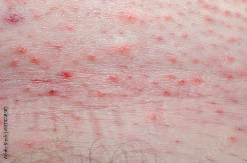 Human body wound. Skin irritation after shaving, pimples and acne and fungus.