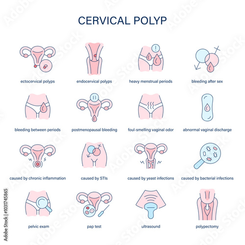 Cervical Polyp symptoms, diagnostic and treatment vector icons. Medical icons.