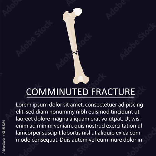 comminuted fracture vector illustration