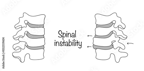 Spinal instability