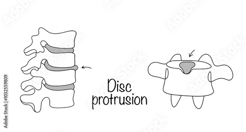Disc protrusion