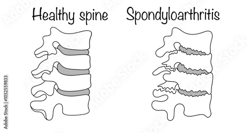 Spondyloarthritis