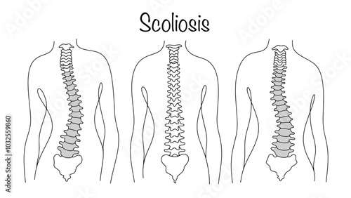 Scoliosis