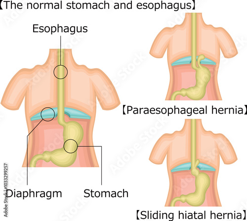 食道　胃　裂孔ヘルニア　イラスト　英語