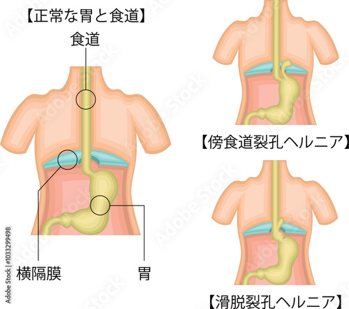 食道　胃　裂孔ヘルニア　イラスト　日本語