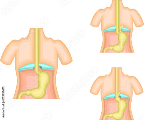 食道　胃　裂孔ヘルニア　イラスト photo