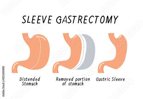Sleeve Gastrectomy, Vertical Gastrectomy for Weight loss surgery