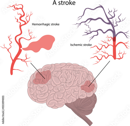 . Hemorrhagic stroke and ischemic stroke of the brain.