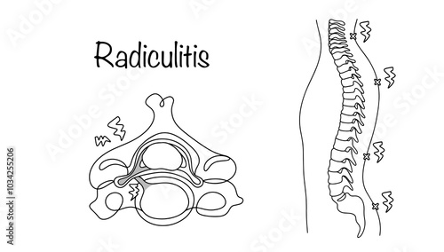 Radiculitis