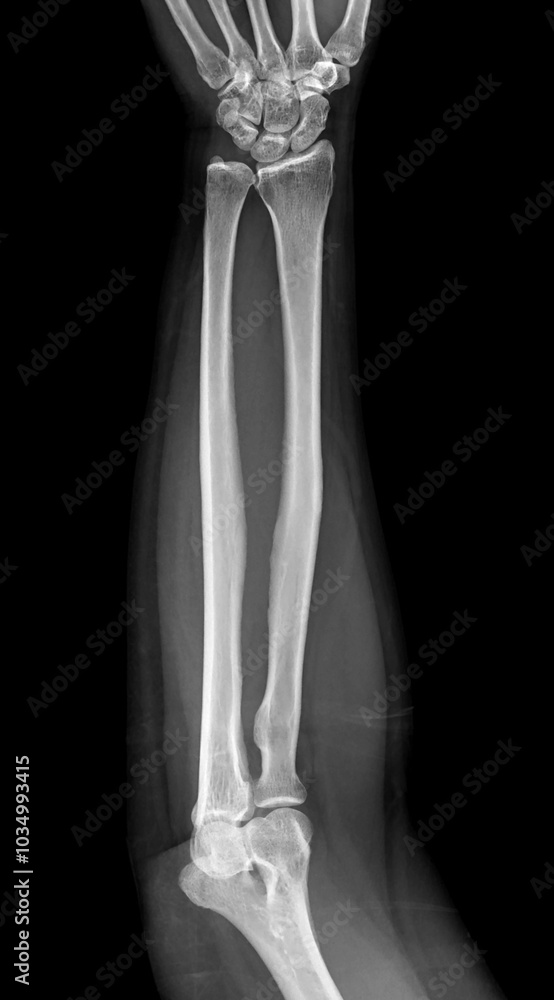 X-ray image of the forearm showing the radius and ulna bones in proper alignment, with no visible fractures or abnormalities. X-ray image of the forearm showing the radius and ulna bones in proper alignment, with no visible fractures or abnormalities.