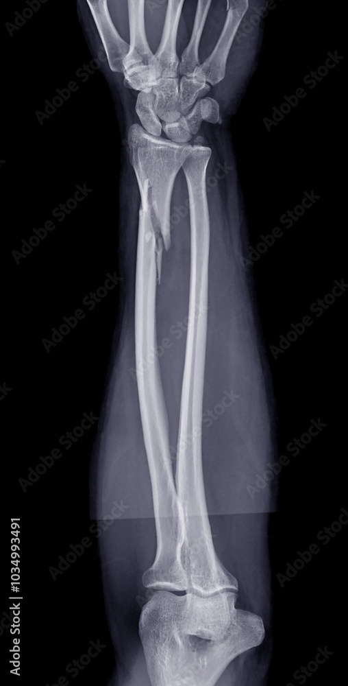 X-ray of the forearm displaying a radius bone fracture, critical for evaluating the extent of the injury and planning treatment. X-ray of the forearm displaying a radius bone fracture, critical for evaluating the extent of the injury and planning treatment.