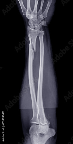 Принти на полотні X-ray of the forearm displaying a radius bone fracture, critical for evaluating the extent of the injury and planning treatment