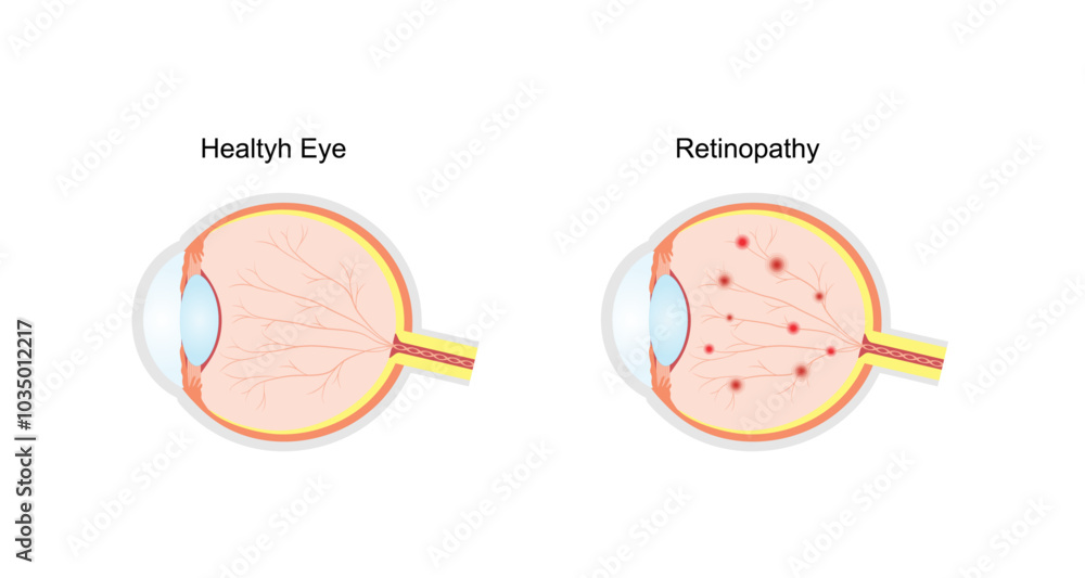 Diabetic retinopathy. Healthy eye and damaged eye. Retinal damage ...