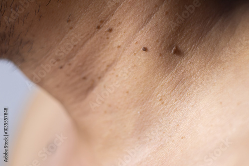 Skin tags or soft tissue tumors that are a skin problem on the neck