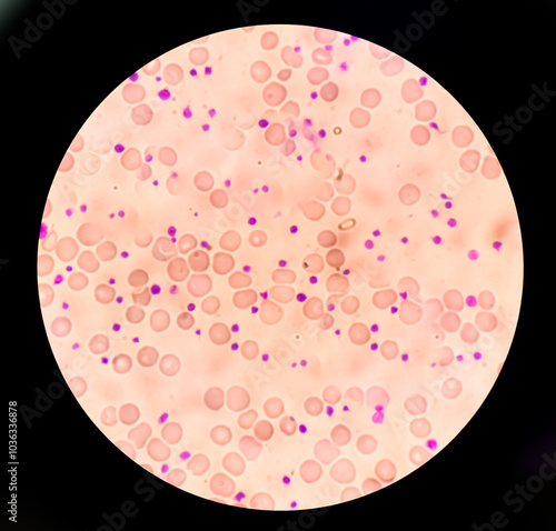 Thrombocytosis blood smear, present abnormal high platelet count analyze by microscope photo