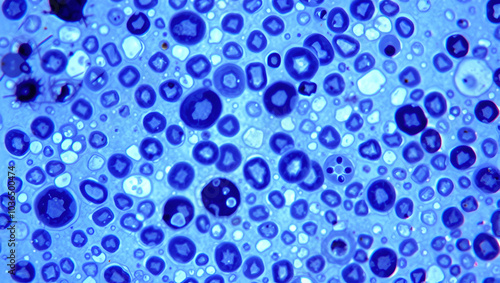 Bone marrow study, microscopically show megakaryocytic pleomorphism. Megakaryocytic hyperplasia. photo