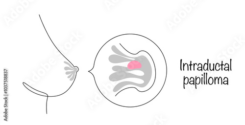 Intraductal papilloma