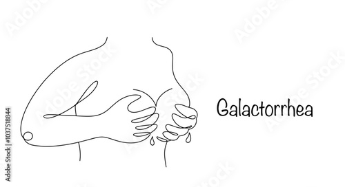 Galactorrhea